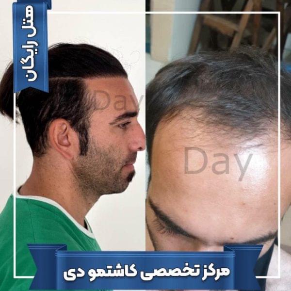 کاشت مو 30 1699168107 600x600