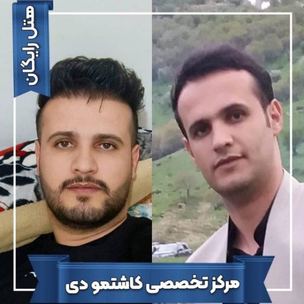 کاشت مو 31 1699168126 600x600