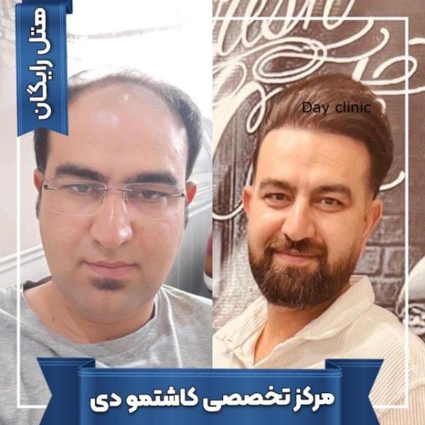 کاشت مو 32 1699168289 600x600