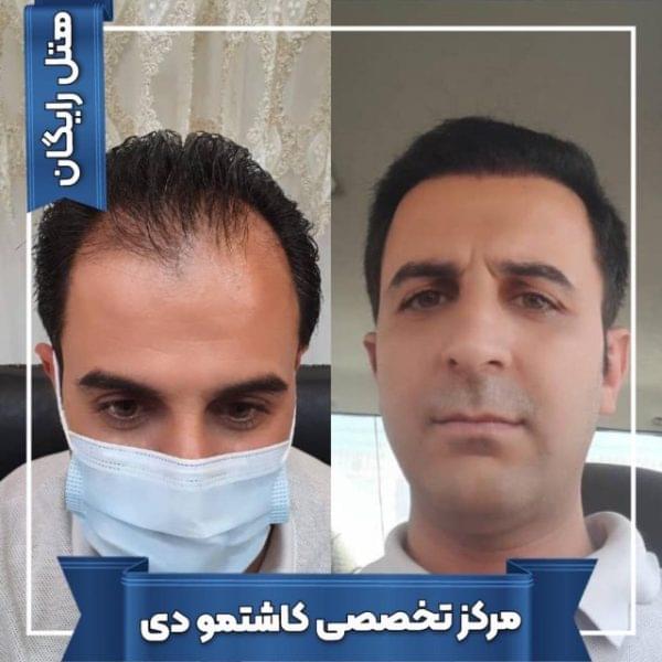 کاشت مو 33 1699168306 600x600