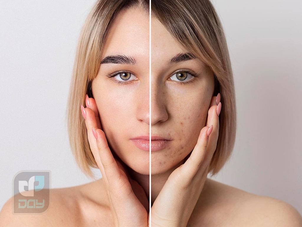 لیزر پیکو چیست؟ کاربردها، مزایا، عوارض 2 لیزر پیکوشور-1