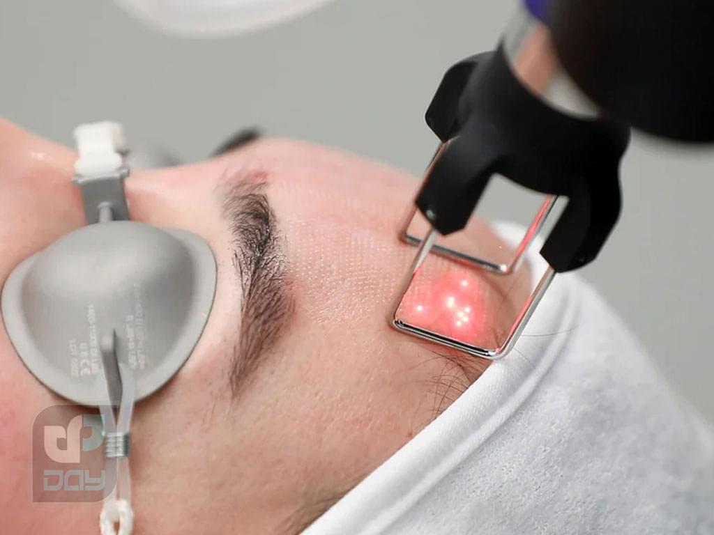 لیزر پیکو چیست؟ کاربردها، مزایا، عوارض 5 لیزر پیکوشور-4