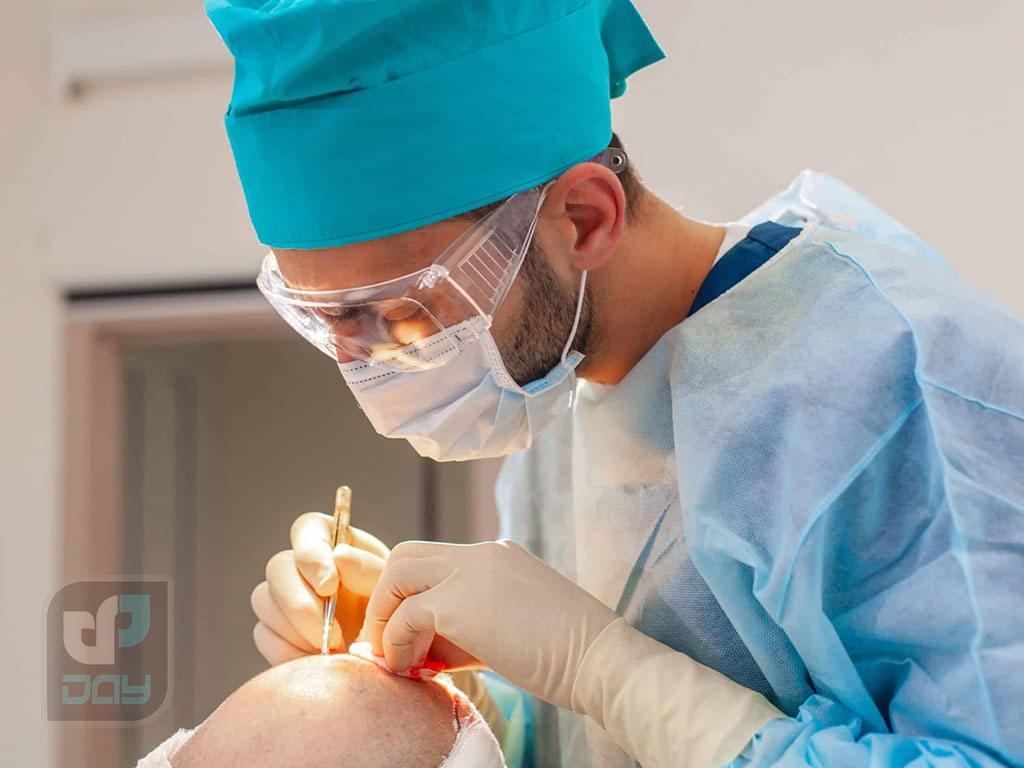 آیا کاشت مو درد دارد؟ بررسی واقعیتهای قبل، حین و بعد از عمل کاشت مو 2 آیا کاشت مو درد دارد-4