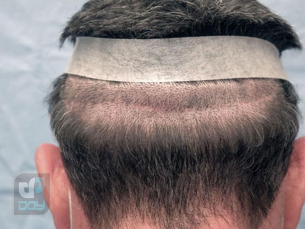 بانک مو در کاشت مو چیست و چرا اهمیت دارد؟ 2 بانک مو-2