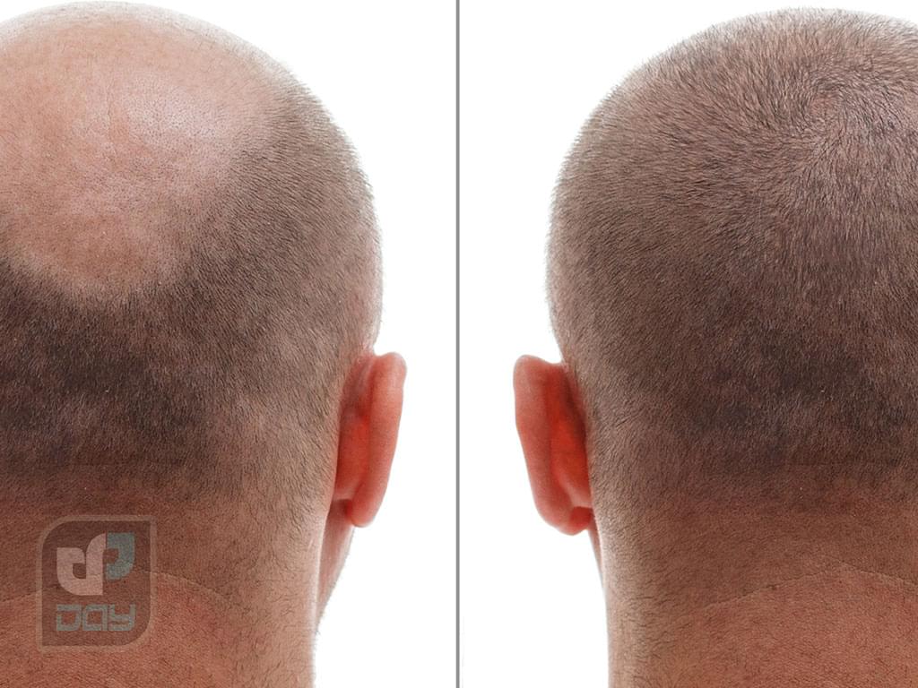 بانک مو در کاشت مو چیست و چرا اهمیت دارد؟ 5 بانک مو-5