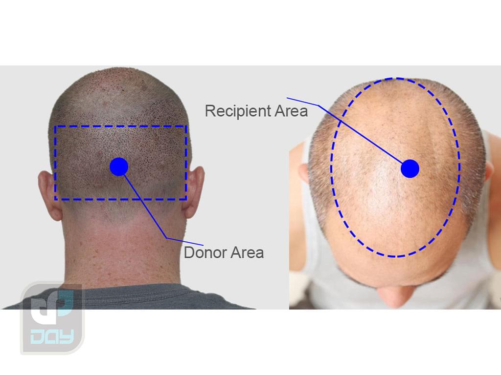 بانک مو در کاشت مو چیست و چرا اهمیت دارد؟ 6 بانک مو-7