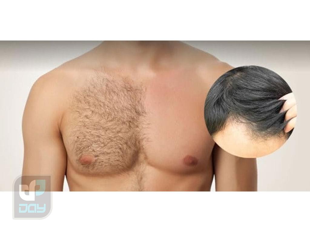 بانک مو در کاشت مو چیست و چرا اهمیت دارد؟ 7 بانک مو-8