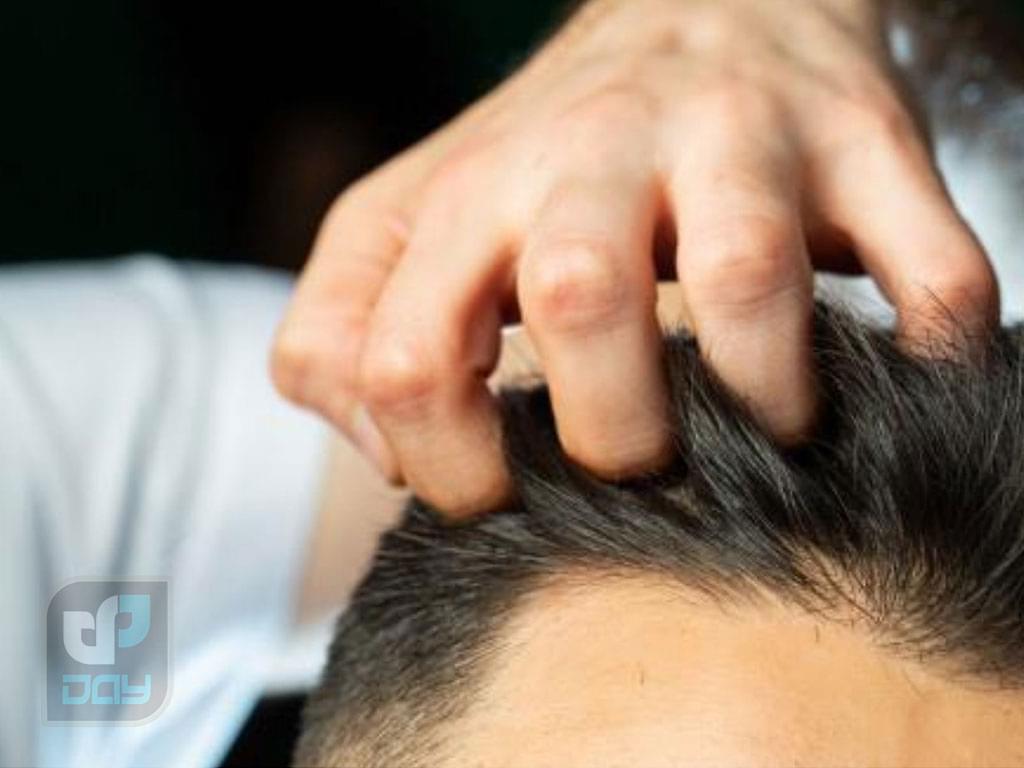 تفاوت کاشت موی طبیعی و مصنوعی | بررسی کامل روشها، مزایا، معایب و ماندگاری 3 تفاوت کاشت موی طبیعی و مصنوعی-2