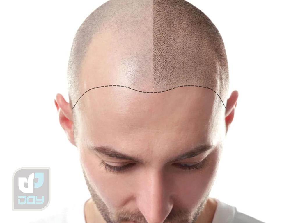 تفاوت کاشت موی طبیعی و مصنوعی | بررسی کامل روشها، مزایا، معایب و ماندگاری 5 تفاوت کاشت موی طبیعی و مصنوعی-3