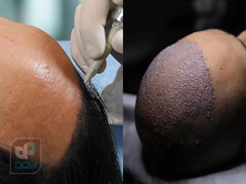 تفاوت کاشت موی طبیعی و مصنوعی | بررسی کامل روشها، مزایا، معایب و ماندگاری 4 تفاوت کاشت موی طبیعی و مصنوعی-4