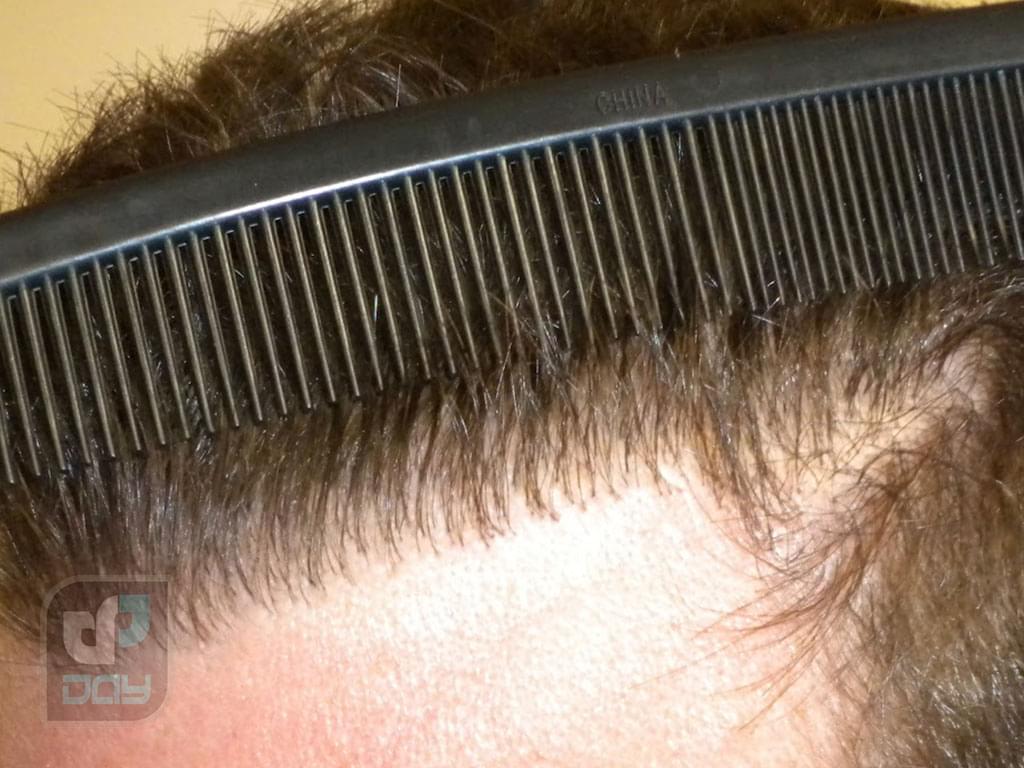 تفاوت کاشت موی طبیعی و مصنوعی | بررسی کامل روشها، مزایا، معایب و ماندگاری 2 تفاوت کاشت موی طبیعی و مصنوعی-1