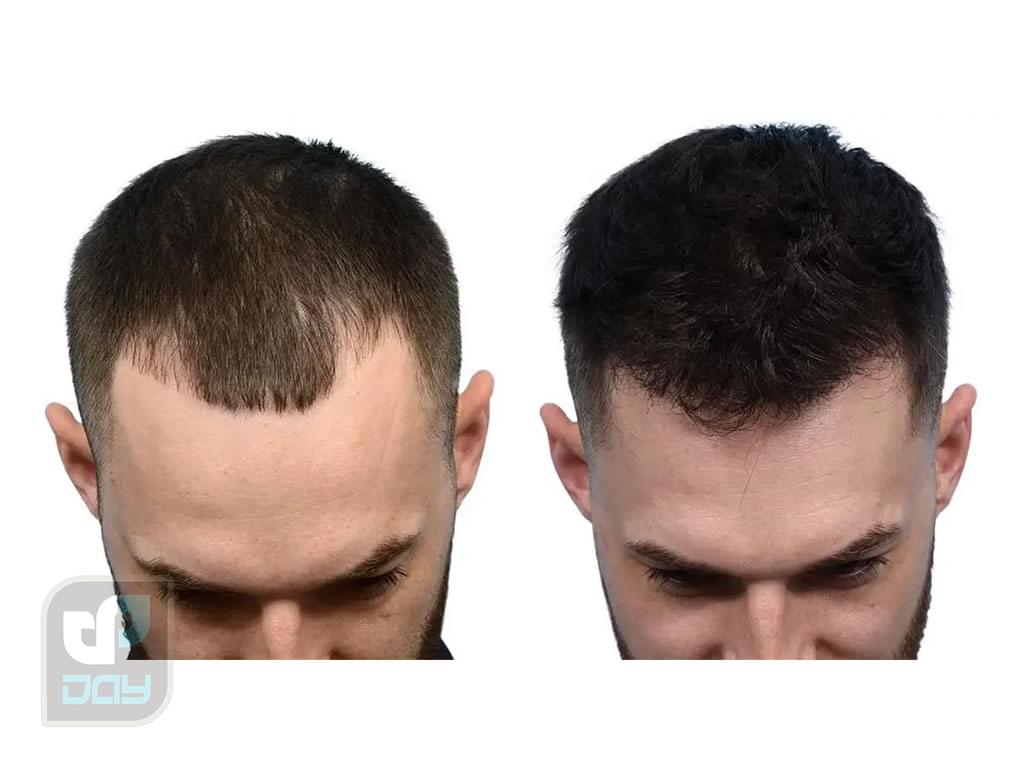 کاشت مو در شیراز با چه قیمتی انجام میشود؟ راهنمای جامع هزینهها در کلینیک دی 2 هزینه کاشت مو در شیراز-1