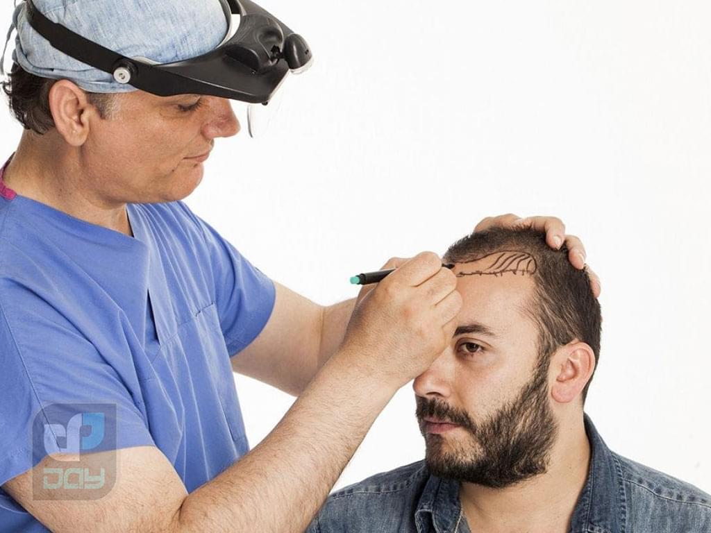 کاشت مو در شیراز با چه قیمتی انجام میشود؟ راهنمای جامع هزینهها در کلینیک دی 3 هزینه کاشت مو در شیراز-2