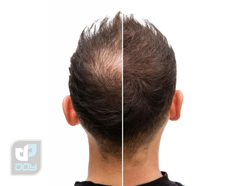 کاشت مو در شیراز با چه قیمتی انجام میشود؟ راهنمای جامع هزینهها در کلینیک دی 4 هزینه کاشت مو در شیراز-3