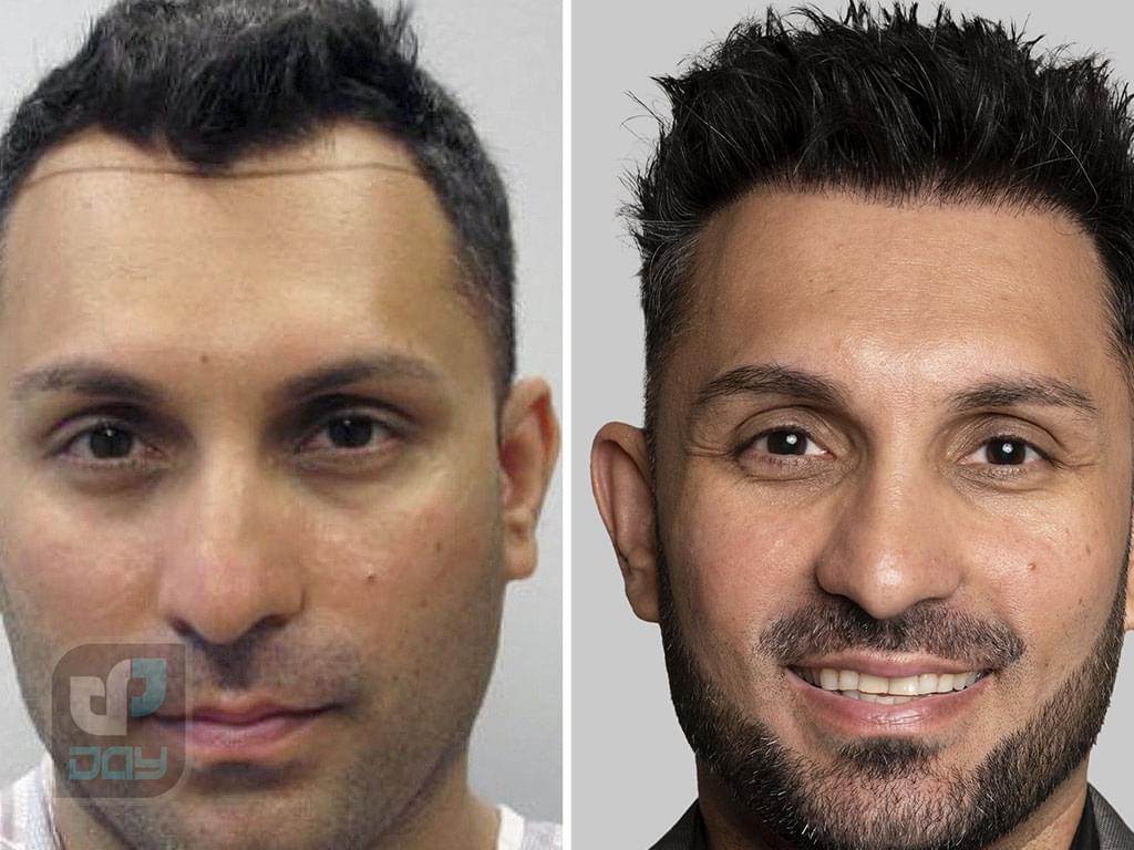 کاشت مو در شیراز با چه قیمتی انجام میشود؟ راهنمای جامع هزینهها در کلینیک دی 5 کاشت مو در شیراز نمونه کار کلینیک دی