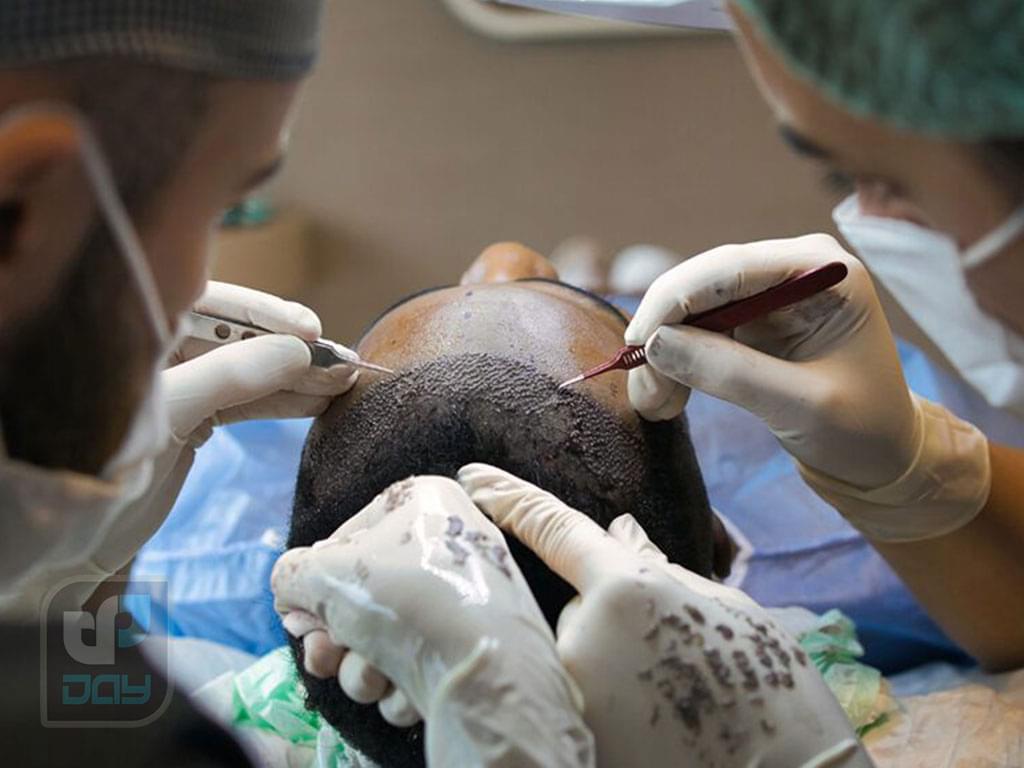 کاشت مو در شیراز با چه قیمتی انجام میشود؟ راهنمای جامع هزینهها در کلینیک دی 6 هزینه کاشت مو در شیراز-5