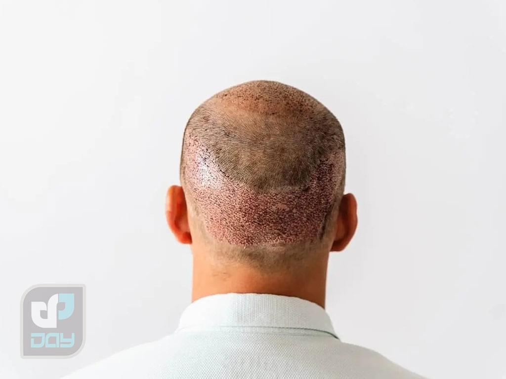 بانک مو در کاشت مو چیست و چرا اهمیت دارد؟ 3 بانک مو-3