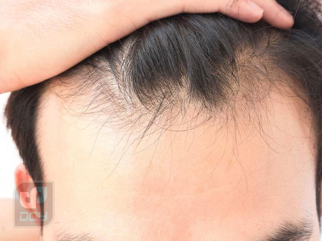 کاشت مو برای آقایان یا بانوان؛ راهنمای کامل انتخاب روش، مراحل انجام و نکات کلیدی 2 کاشت مو برای آقایان یا بانوان-1