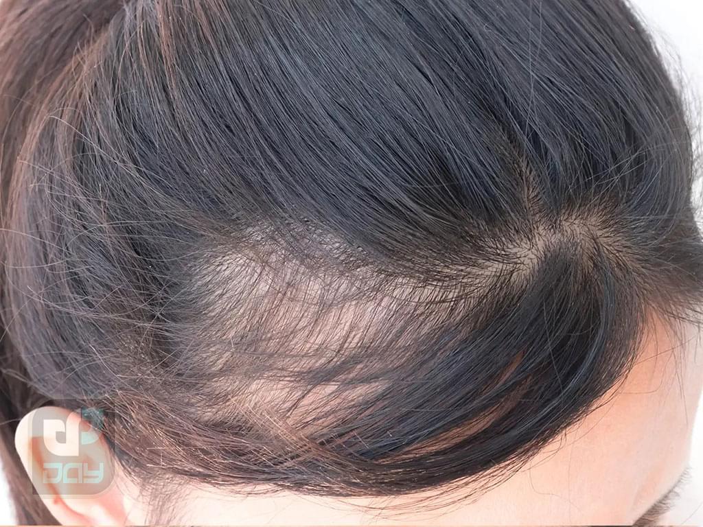 کاشت مو برای آقایان یا بانوان؛ راهنمای کامل انتخاب روش، مراحل انجام و نکات کلیدی 3 کاشت مو برای آقایان یا بانوان-2