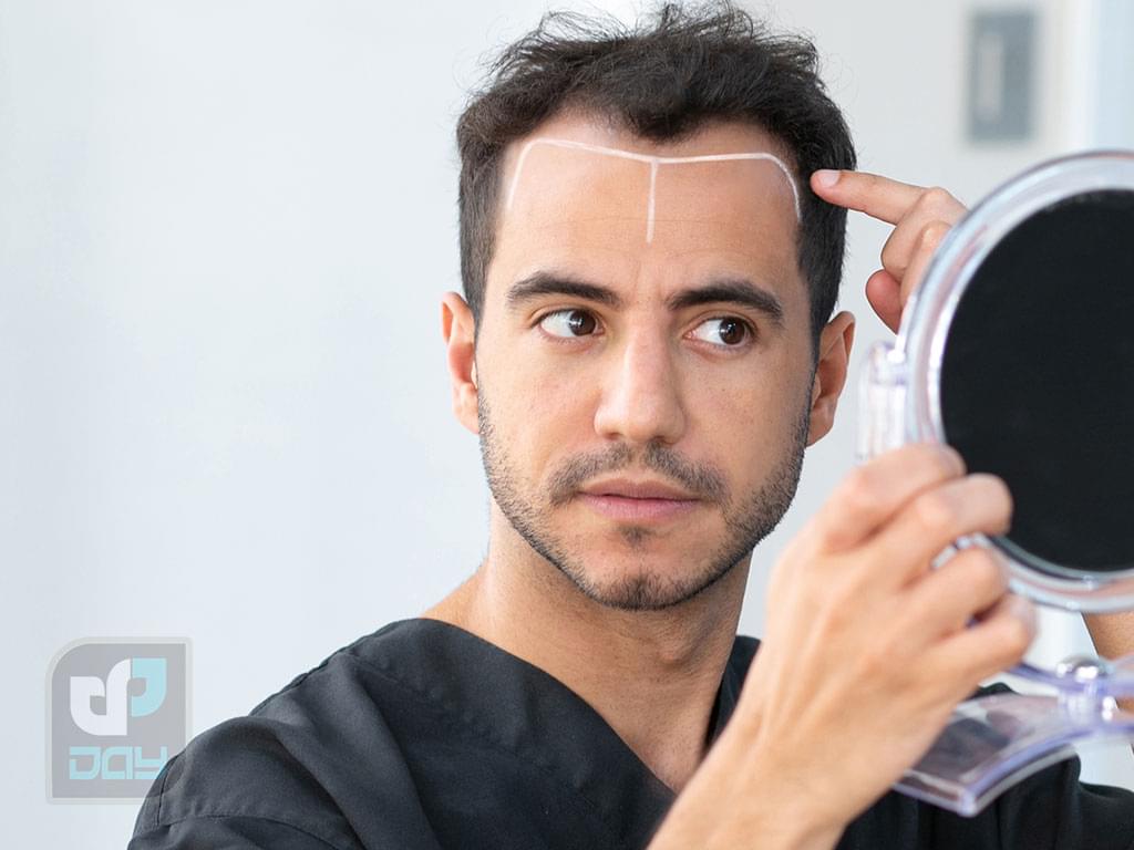 کاشت مو برای آقایان یا بانوان؛ راهنمای کامل انتخاب روش، مراحل انجام و نکات کلیدی 4 کاشت مو برای آقایان یا بانوان-3