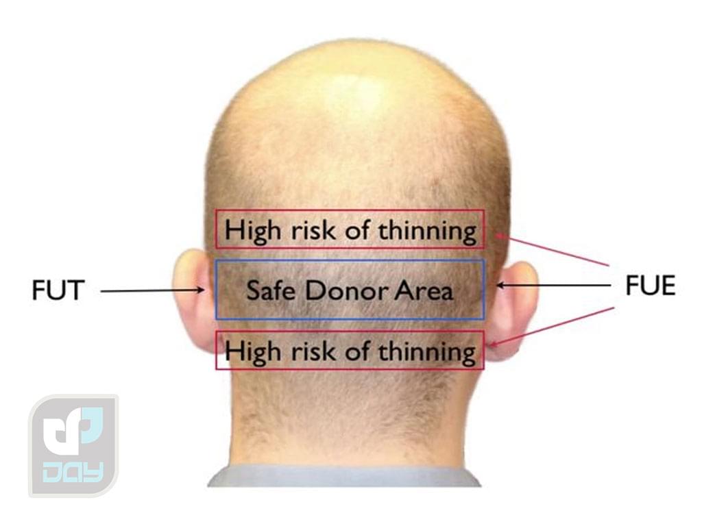 کاشت مو برای آقایان یا بانوان؛ راهنمای کامل انتخاب روش، مراحل انجام و نکات کلیدی 6 مو برای آقایان یا بانوان 5