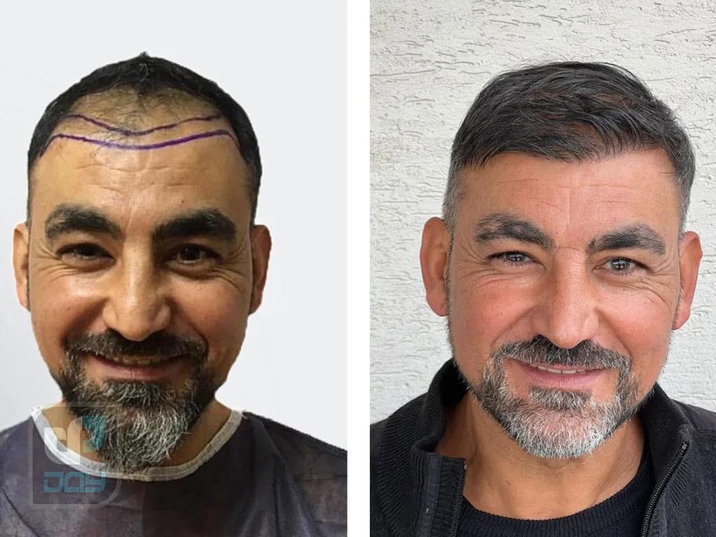 کاشت مو برای آقایان یا بانوان؛ راهنمای کامل انتخاب روش، مراحل انجام و نکات کلیدی 7 کاشت مو برای آقایان یا بانوان-6