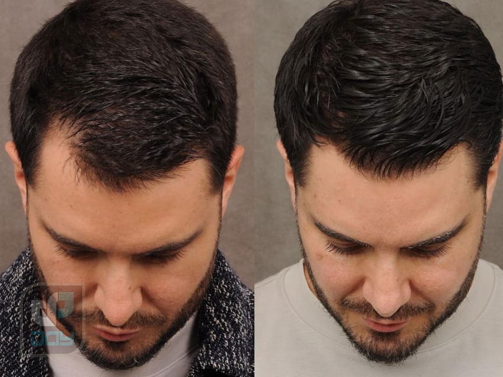 کاشت مو برای آقایان یا بانوان؛ راهنمای کامل انتخاب روش، مراحل انجام و نکات کلیدی 8 کاشت مو برای آقایان یا بانوان-7