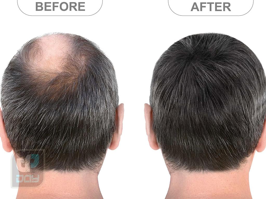 بهترین کلینیک کاشت مو در شیراز 5 کاشت مو در شیراز-3