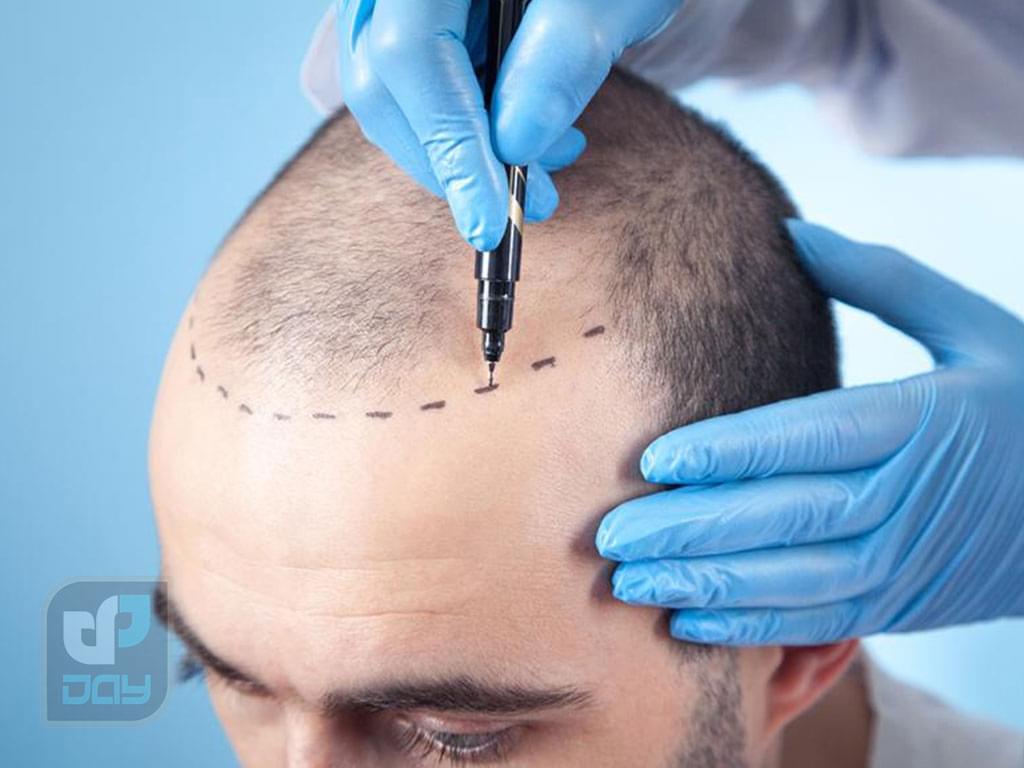 بهترین کلینیک کاشت مو در شیراز 4 کاشت مو در شیراز-روش های کاشت مو-3