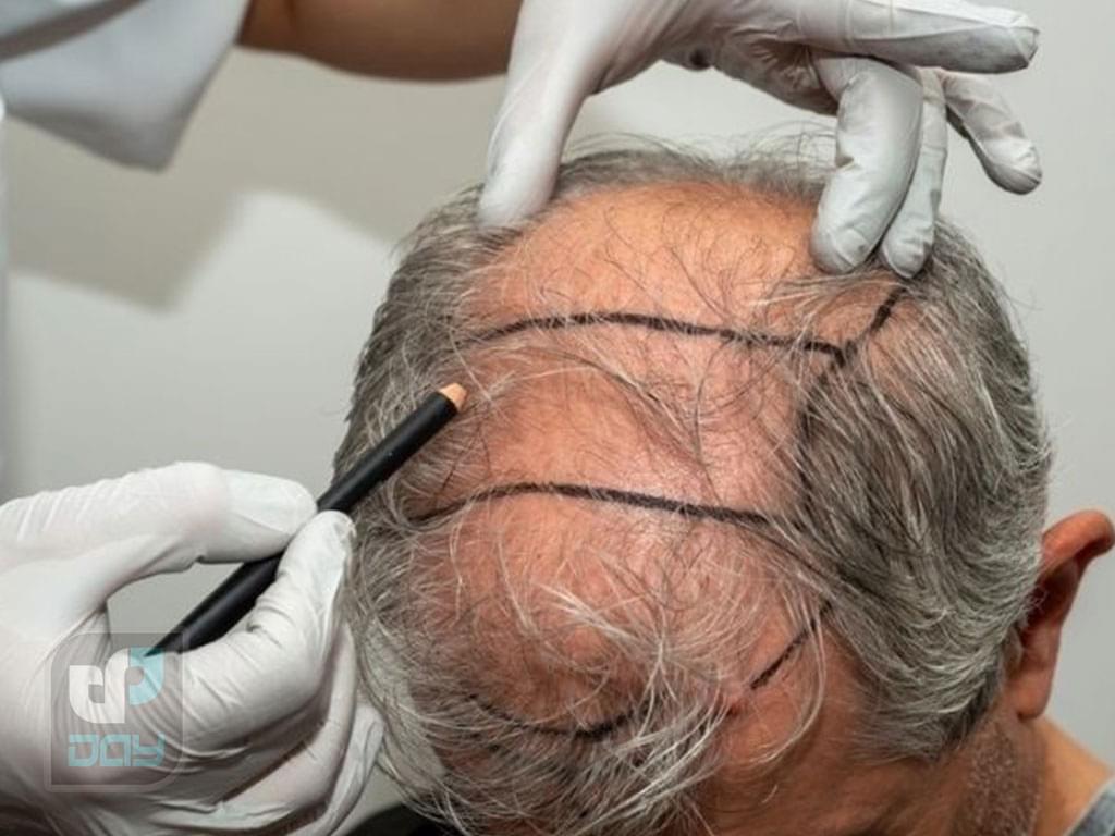 بهترین کلینیک کاشت مو در شیراز 3 کاشت مو در شیراز-روش های کاشت مو