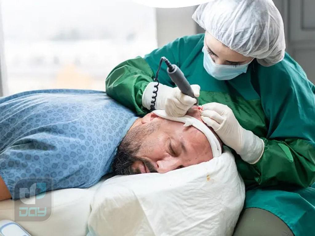 بهترین کلینیک کاشت مو در شیراز 6 کاشت مو در شیراز-روند انجام کاشت مو در کلینیک دی