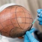 کاشت مو درد دارد عکس شاخص