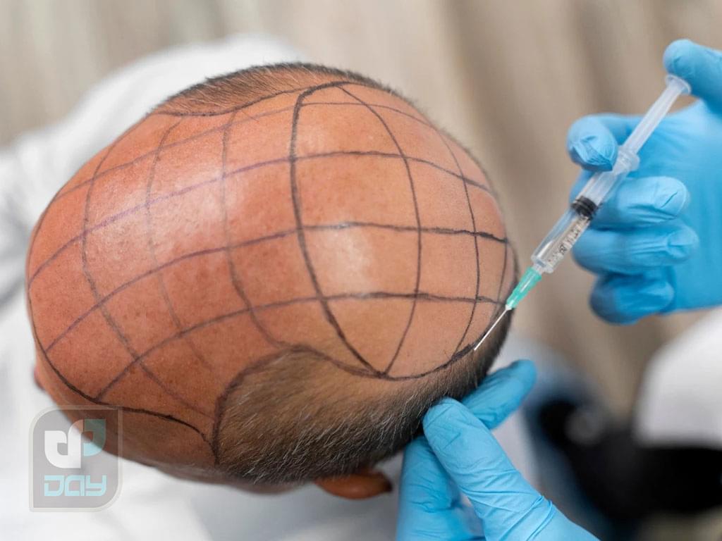 آیا کاشت مو درد دارد؟ بررسی واقعیتهای قبل، حین و بعد از عمل کاشت مو 1 کاشت مو درد دارد عکس شاخص