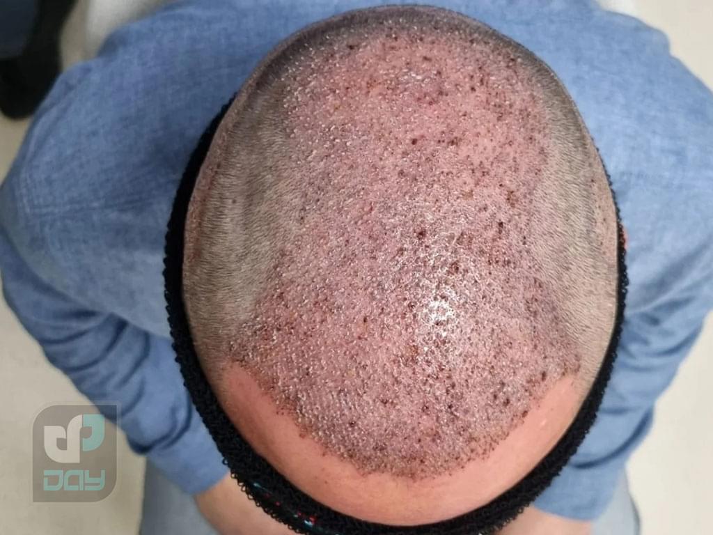 بهترین کلینیک کاشت مو در شیراز 7 کاشت مو در شیراز-پشتیبانی پس از کاشت