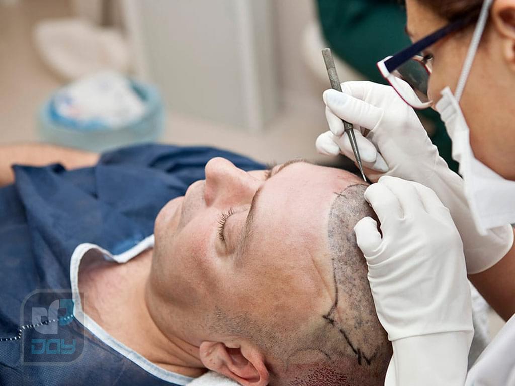 کاشت مو شیراز بهتره یا تهران؟ مقایسه واقعی تا انتخاب راحتتر 4 کاشت مو شیراز بهتره یا تهران-4