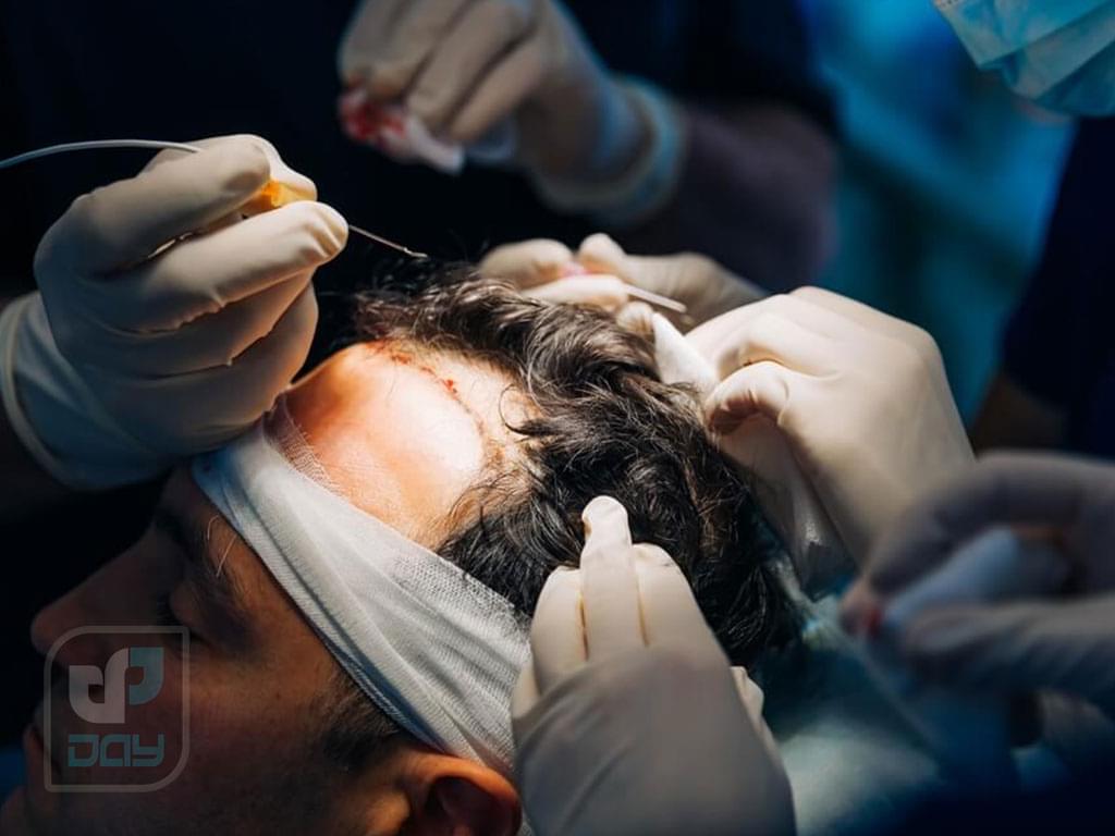 کاشت مو شیراز بهتره یا تهران؟ مقایسه واقعی تا انتخاب راحتتر 5 کاشت مو شیراز بهتره یا تهران-5