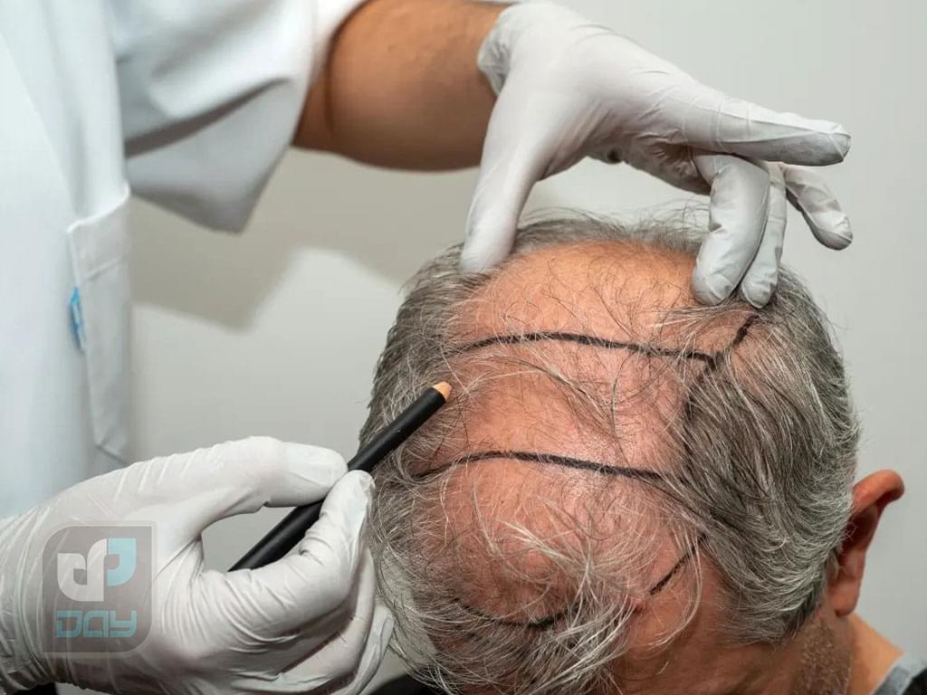 بهترین دکتر کاشت مو در شیراز در کلینیک دی 2 بهترین دکتر کاشت مو در شیراز- متخصصین کلینیک دی