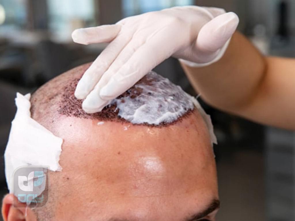 شامپوی مناسب بعد از کاشت مو؛ چه محصولی انتخاب کنیم؟ 2 شامپو بعد از کاشت مو-1