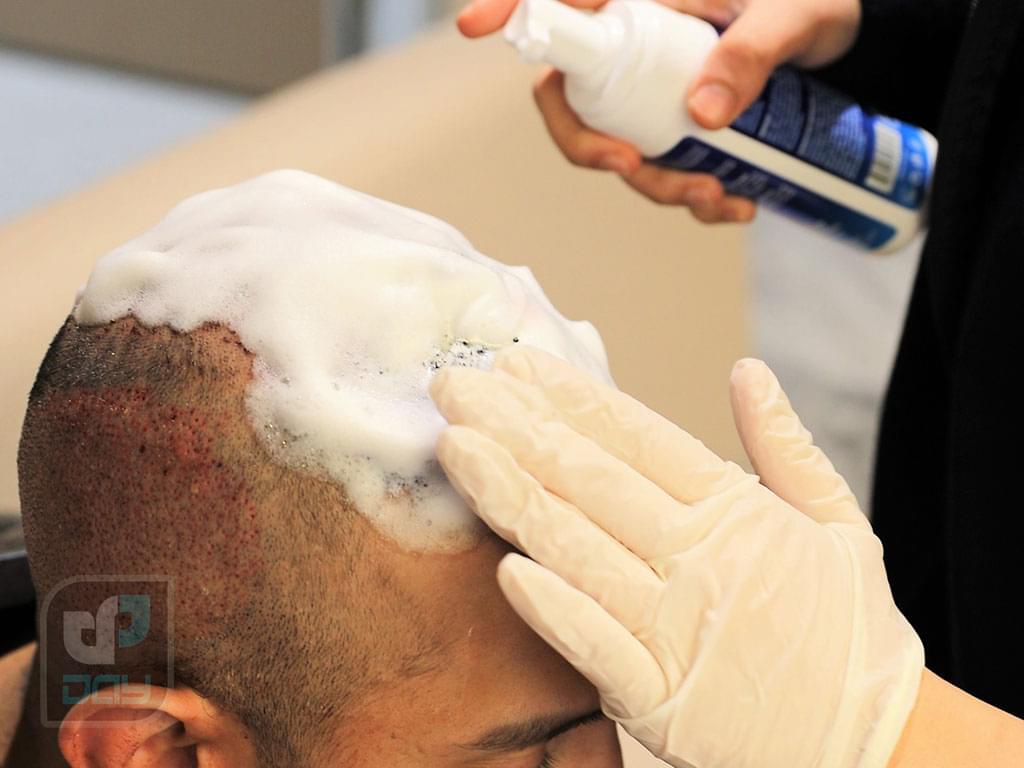 شامپوی مناسب بعد از کاشت مو؛ چه محصولی انتخاب کنیم؟ 5 شامپو بعد از کاشت مو-3