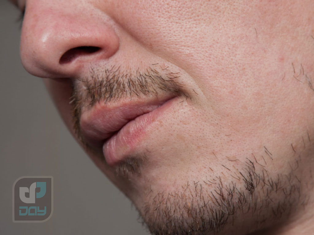 کاشت ریش در شیراز؛ بررسی روشها، هزینه ۱۴۰۴ و مزایا 3 کاشت ریش در شیراز-1