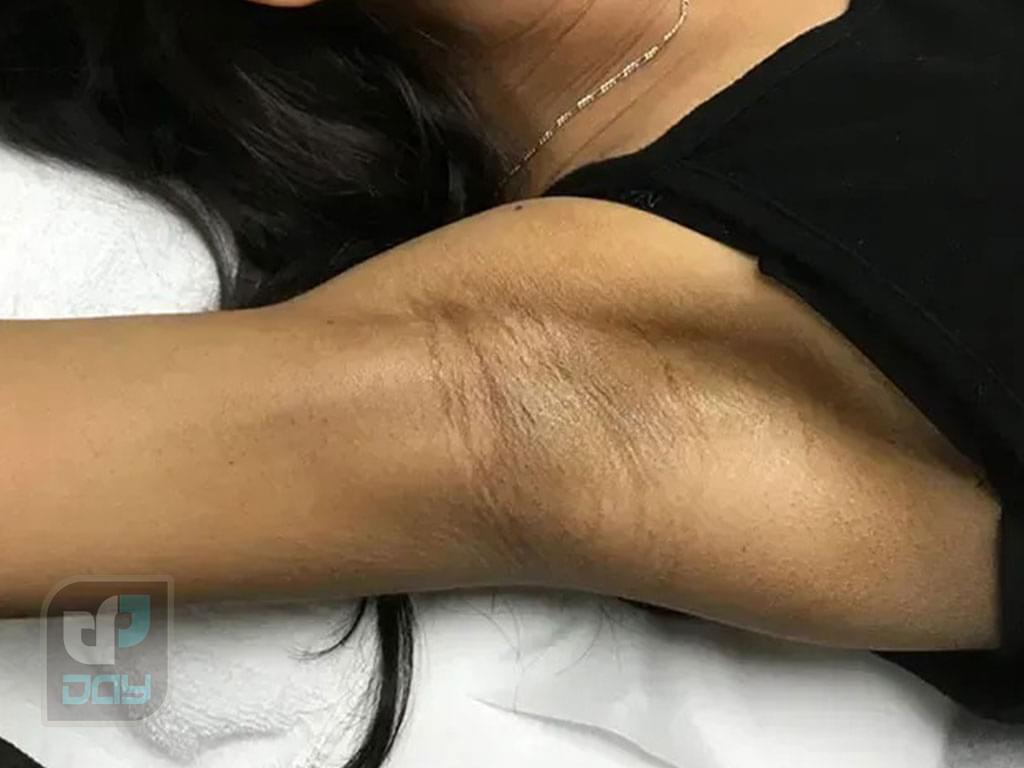 لیزر الکساندرایت یا دایود؟ کدام دستگاه برای حذف موهای زائد بهتر است؟ 3 تفاوت لیزر الکساندرایت و دایود-2