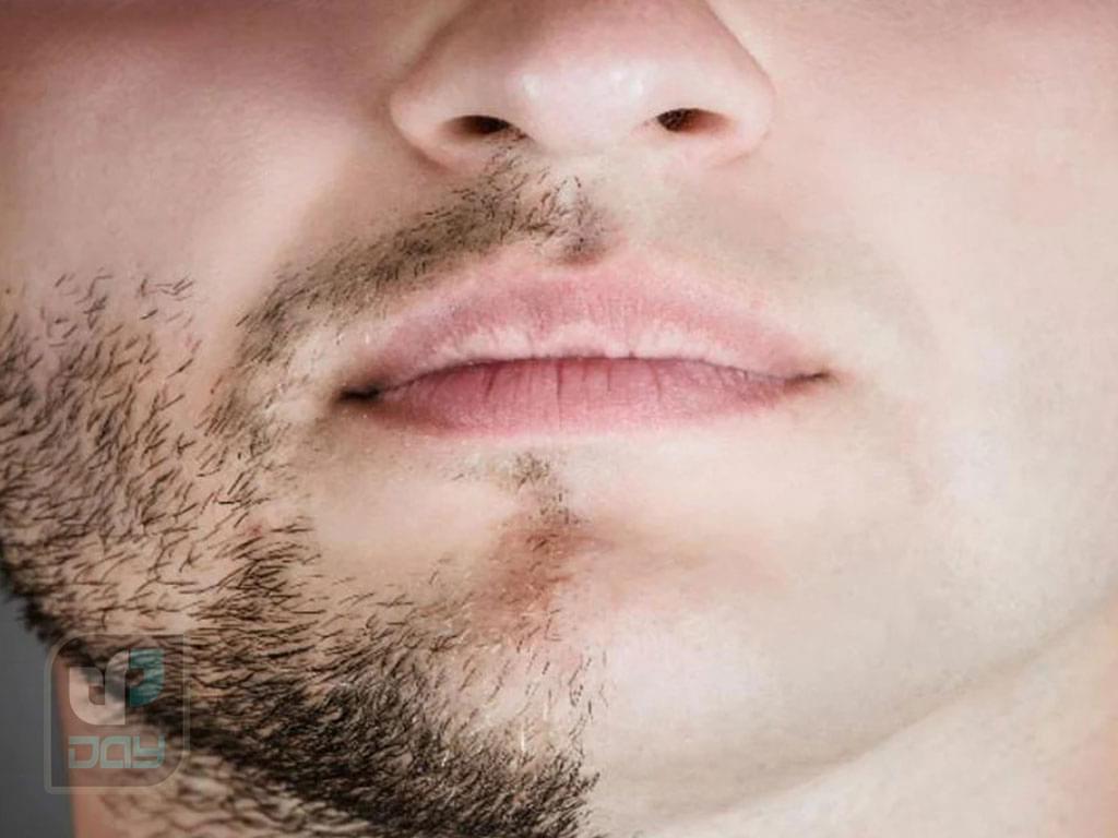 لیزر صورت برای آقایان در شیراز 4 لیزر صورت برای آقایان در شیراز-3