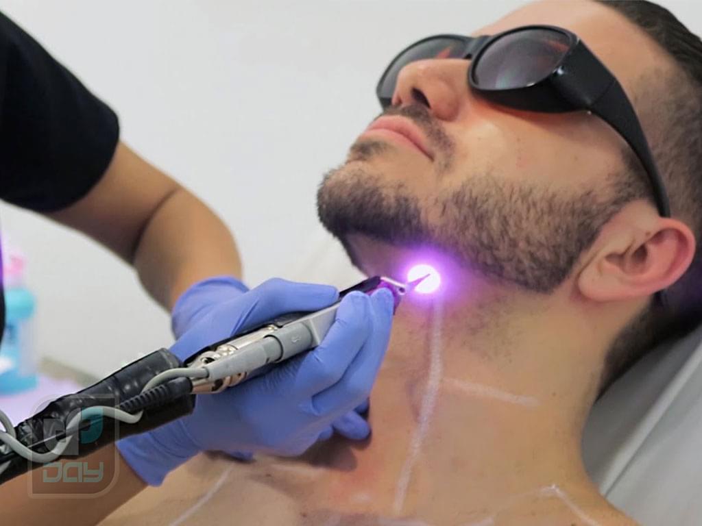 لیزر صورت برای آقایان در شیراز 6 لیزر صورت برای آقایان در شیراز-5