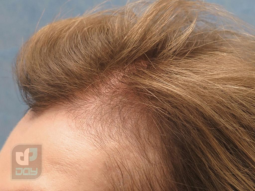 کاشت مو زنان در شیراز 2 کاشت مو زنان در شیراز-1