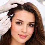 کاشت مو زنان