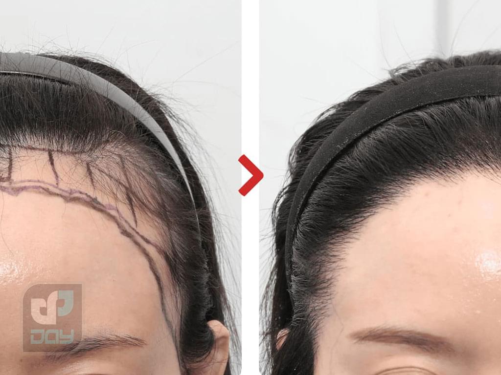 کاشت مو زنان در شیراز 3 کاشت مو زنان در شیراز-2