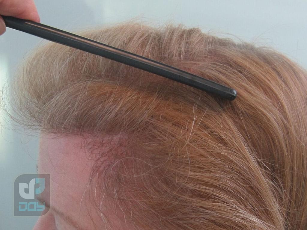 کاشت مو زنان در شیراز 4 کاشت مو زنان در شیراز-3