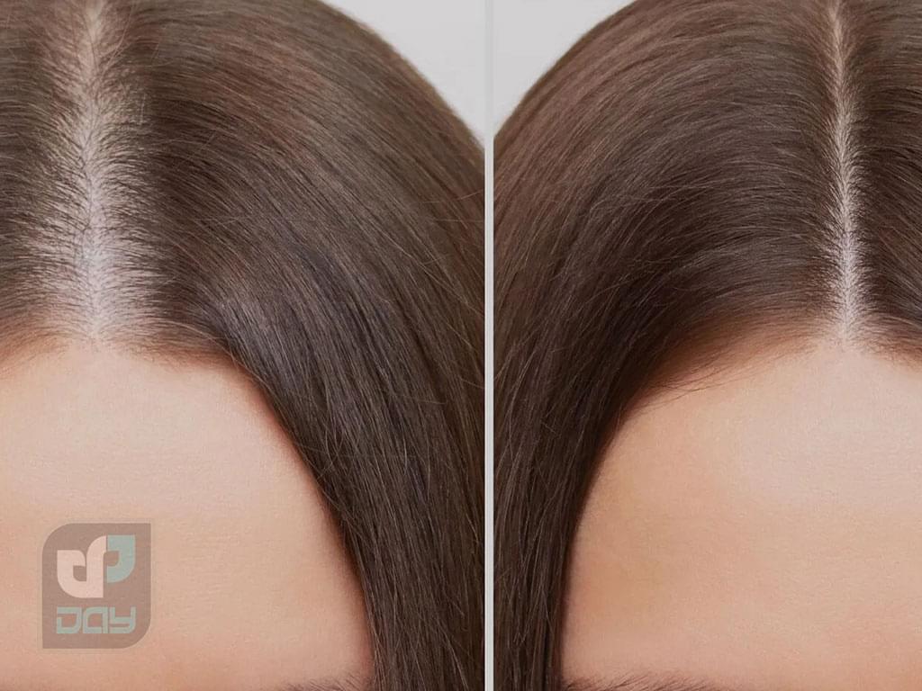 کاشت مو زنان در شیراز 5 کاشت مو زنان در شیراز-4