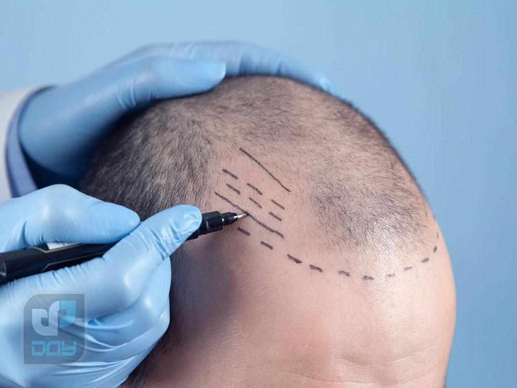 کاشت مو در اصفهان بهتره یا شیراز؟ 1 کاشت مو در اصفهان بهتره یا شیراز عکس شاخص