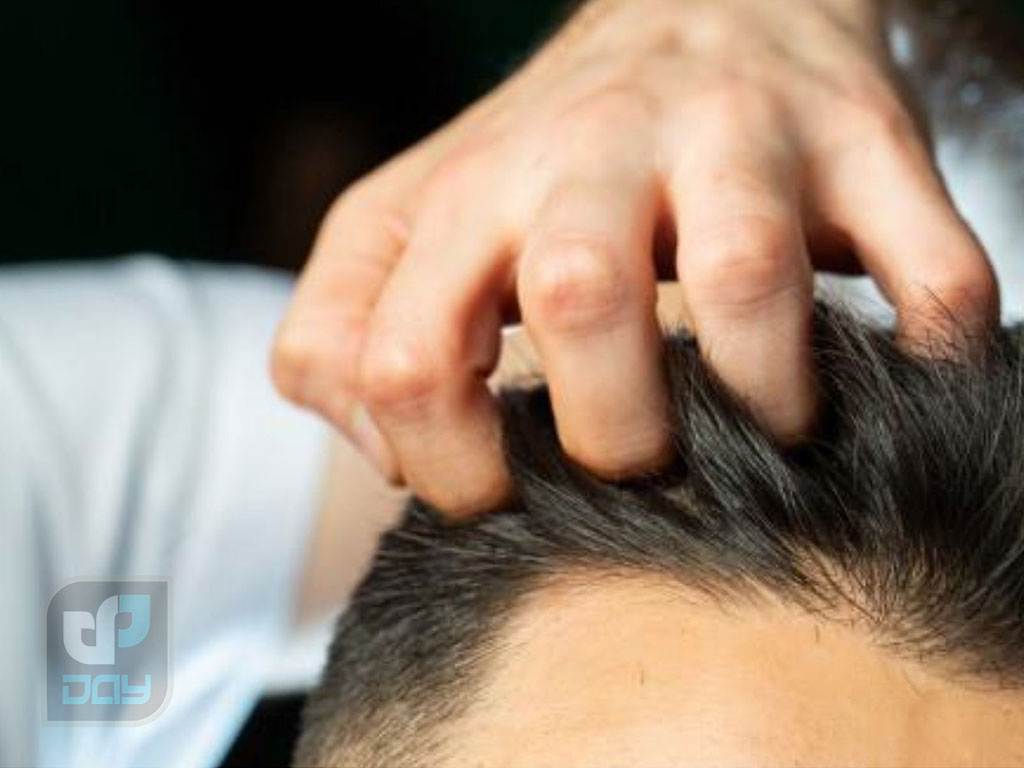کاشت مو در اصفهان بهتره یا شیراز؟ 5 کاشت مو در اصفهان بهتره یا شیراز-1